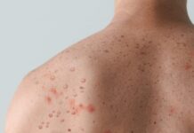 Quatro casos de Mpox são confirmados em Porto Velho