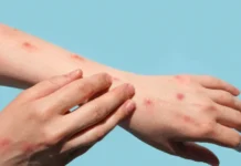 Sobe para 140 número de casos confirmados de Mpox no país, em 2026